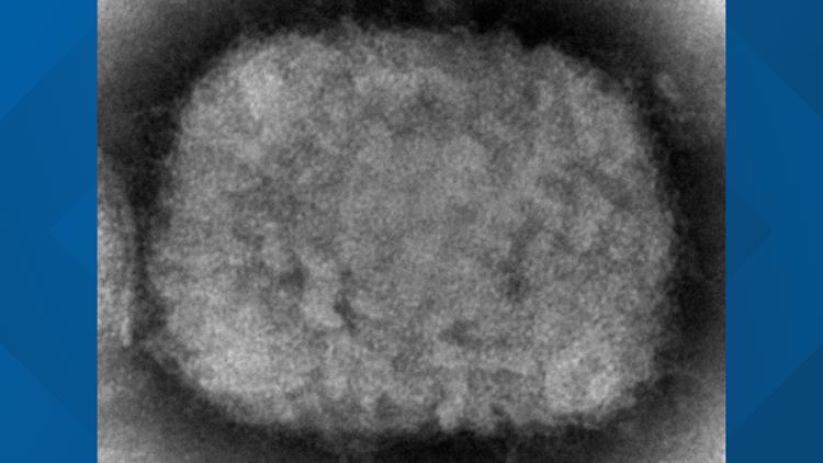 US case of monkeypox reported in Massachusetts man