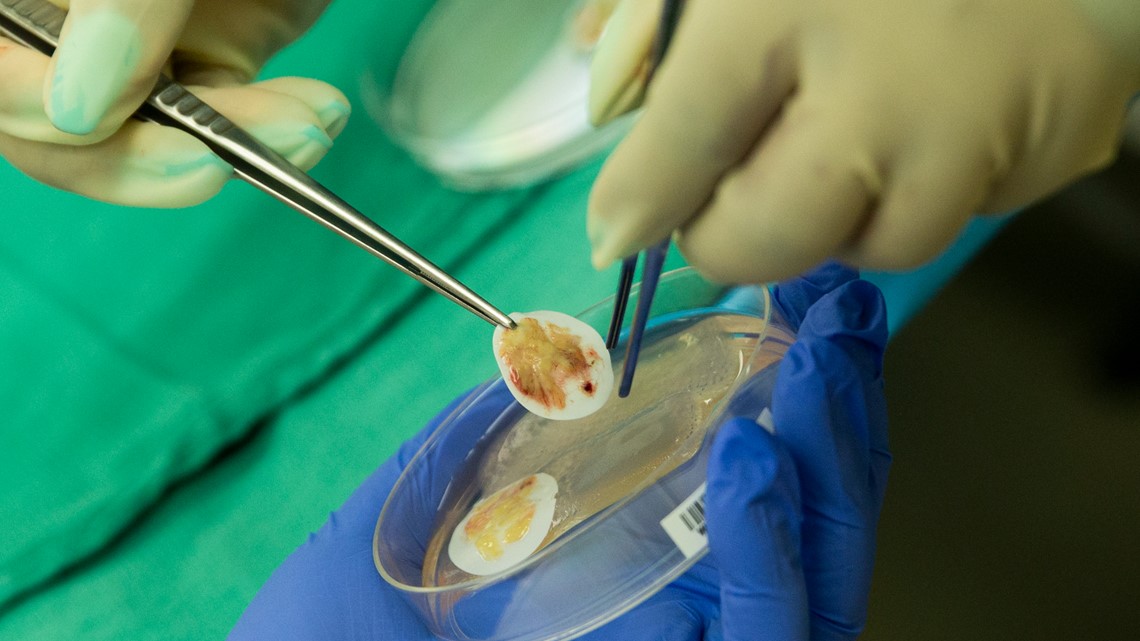 Child will get coronary heart transplant with thymus tissue to struggle rejection Child will get coronary heart transplant with thymus tissue to struggle rejection