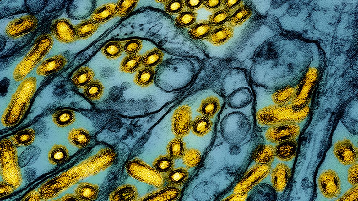 Louisiana resident with nation’s first extreme chicken flu case has died Louisiana resident with nation’s first extreme chicken flu case has died