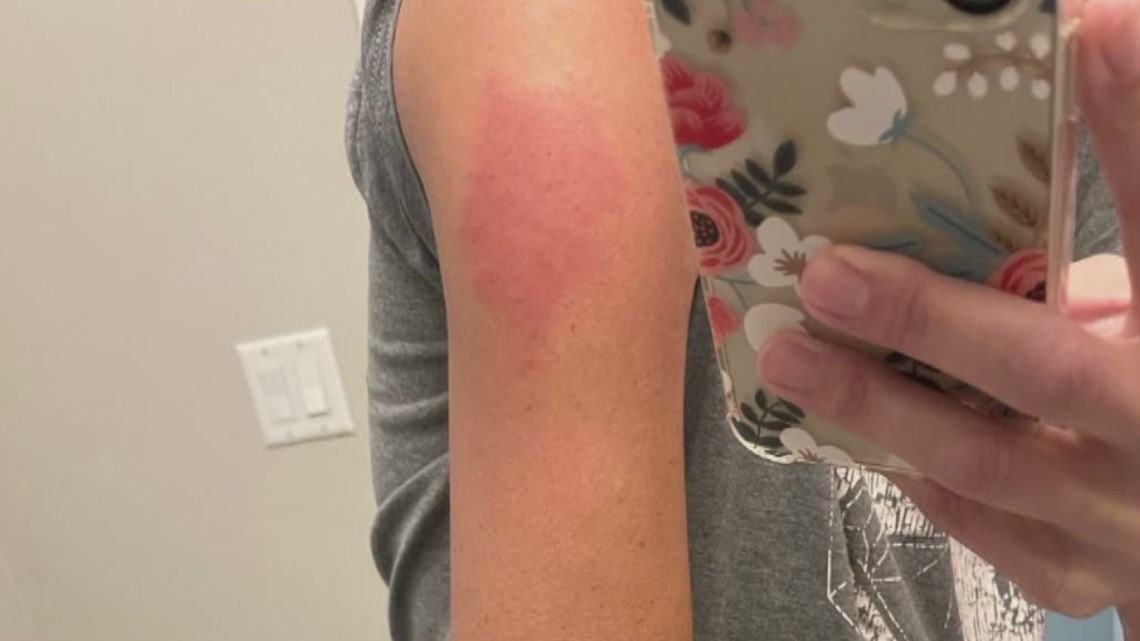 COVID Arm-The side effect of the vaccine is swollen red arm around the shot