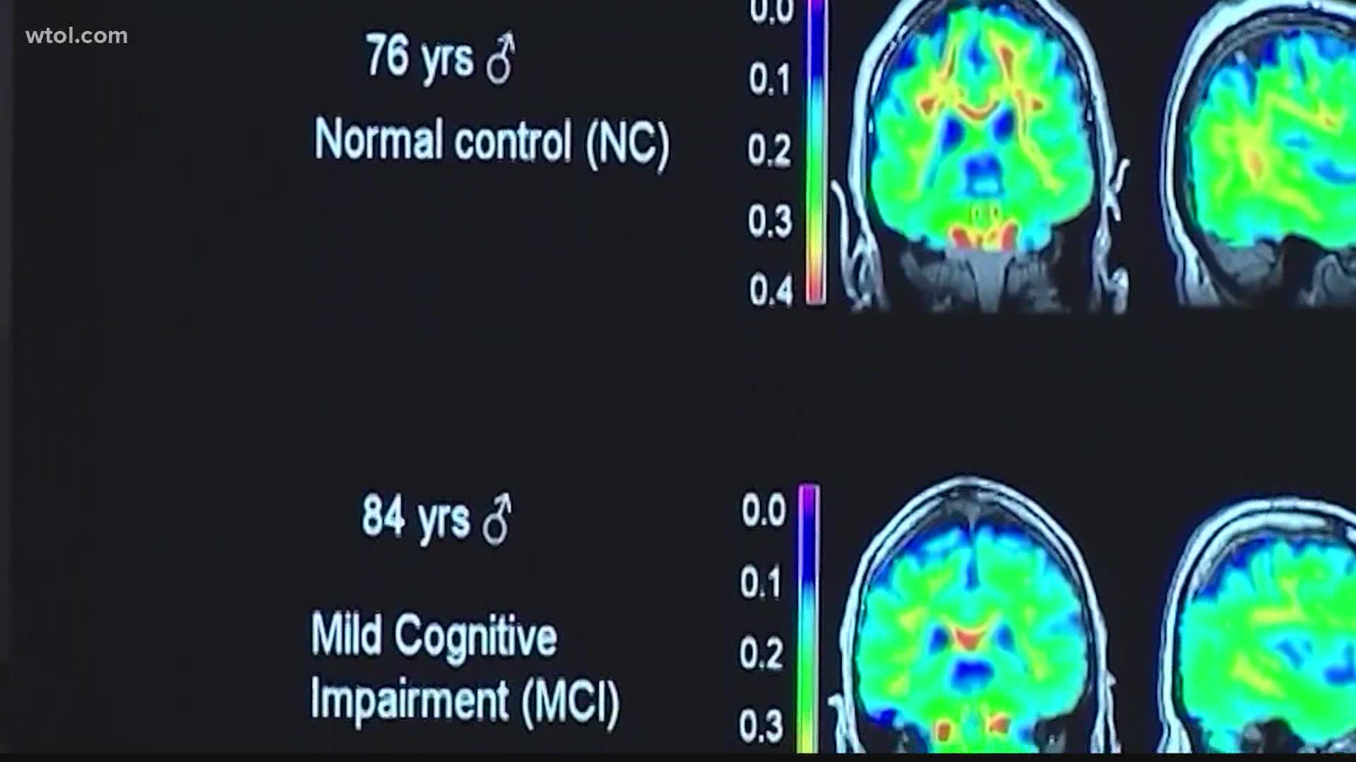 In 2020, an estimated 5.8 million Americans were diagnosed with Alzheimer's. This number is projected to nearly triple to 14 million people by 2060.