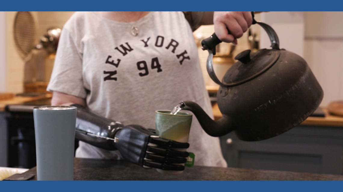 Ohio crash survivor among first women in US to use new advanced prosthetic hand