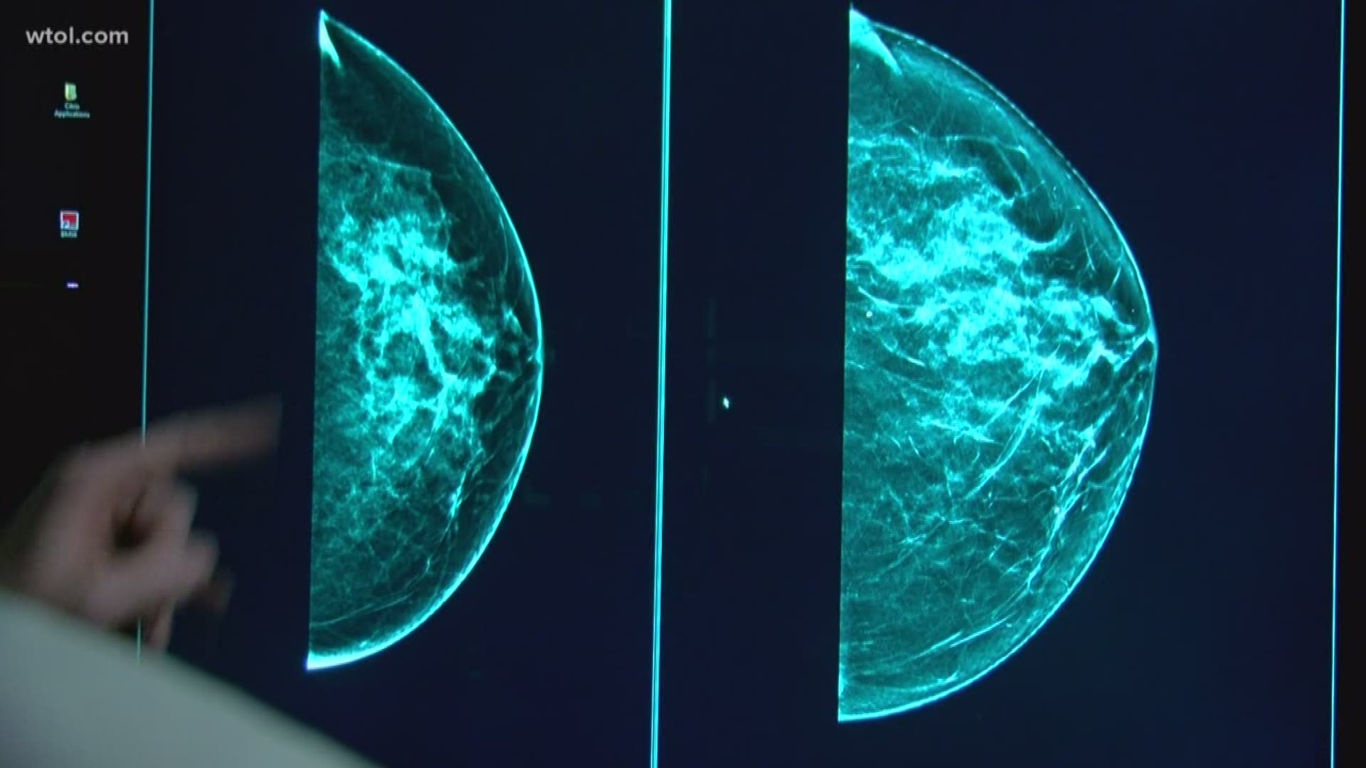 Tomosynthesis screens for early signs of breast cancer in women with no symptoms.
